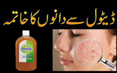 Dettol Se Dano (Pimples) Ka Khatma