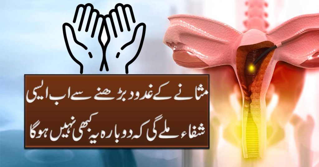 Prostate Glands Treatment In Urdu